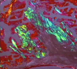 Biopsy specimen