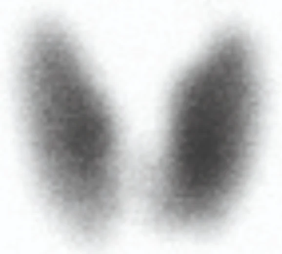 Nuclear medicine scan