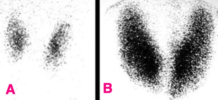Imaging study: A, healthy control; B, patient