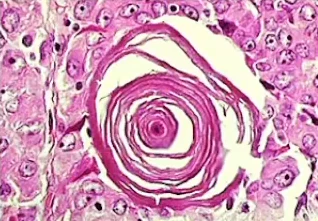 Biopsy specimen (H&E stain)