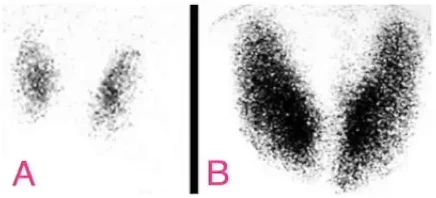 Radioiodine uptake scan